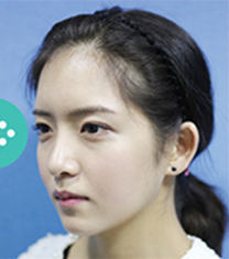 韩国ohkims整形眼形矫正+隆鼻修复+颧骨+下颌角案例_术后