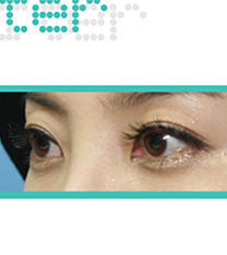 韩国ohkims整形三眼皮矫正案例前后对比图_术后