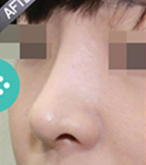 韩国ohkims隆鼻整形手术前后对比照片案例_术后
