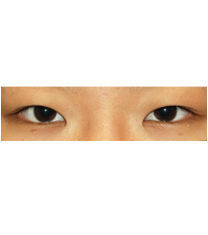 韩国李康元整形魔术开眼角+双眼皮案例对比