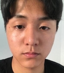 韩国Premiere-韩国普瑞美眼鼻综合手术前后对比照片