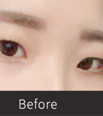 韩国普瑞美张裕珍双眼皮+眼型矫正+开眼角案例图