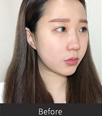 韩国Premiere-韩国张裕珍综合隆鼻整形30天案例前后对比图