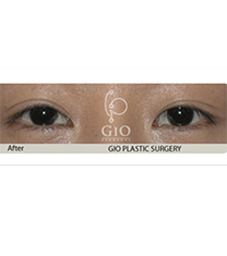 韩国GIO整形外科-韩国GIO双眼不对称矫正前后对比照片
