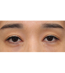 SoonPlus整形外科-韩国soonplus整形医院眼部修复前后对比照片