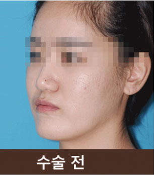 韩国英格整形突嘴手术矫正案例