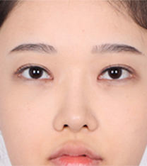 韩国soonplus双眼皮过宽修复+眼提肌矫正前后对比案例