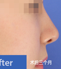 韩国德琳整形外科-韩国梦想整形外科隆鼻案例对比