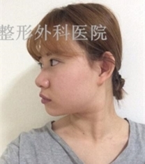 韩国丽温REON整形-韩国丽温鼻综合+下颌角整形前后效果对比