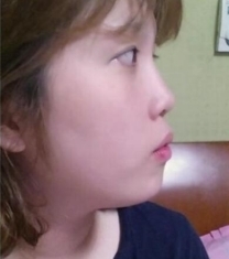 韩国然美之鼻综合手术前后对比照片
