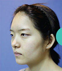 韩国ohkims整形眼形矫正+隆鼻修复+颧骨+下颌角案例_术前
