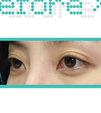 韩国ohkims整形三眼皮矫正案例前后对比图