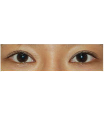 李康元整形外科-韩国李康元整形魔术开眼角+双眼皮案例对比