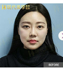 韩国现代美学唇部整形日记分享