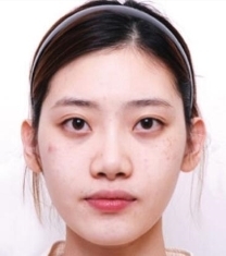 START世大特整形医院-韩国世大特眼鼻综合整形前后对比照片
