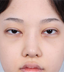 SoonPlus整形外科-韩国soonplus双眼皮过宽修复+眼提肌矫正前后对比案例
