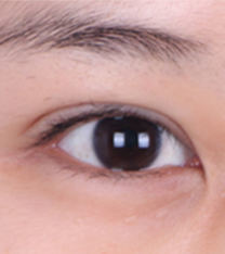SoonPlus整形外科-韩国soonplus双眼皮变单手术案例前后对比照片