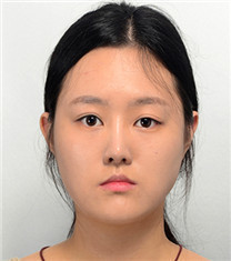 韩国爱宝Everm整形-韩国爱宝地包天手术效果前后对比