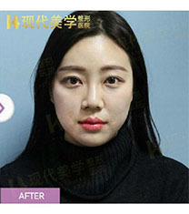 韩国现代美学唇部整形日记分享