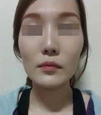 韩国妩丽整形外科轮廓整形案例