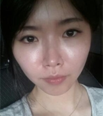 韩国A特整形医院双眼皮+颧弓缩小前后对比照片_术前