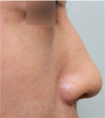 SoonPlus整形外科-韩国soonplus整形外科鼻综合整形对比案例