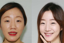 韩国做轮廓好医院科普(一)：英格整形vs齐娥牙科