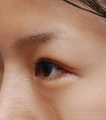 韩国妩婯整形-韩国妩丽医院双眼皮手术日记