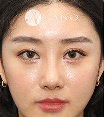 韩国nano鼻修复手术前后对比案例_术后