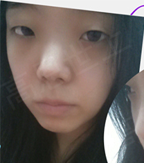 韩国高恩世上整形外科-韩国德丽珍双眼皮+隆鼻手术前后对比