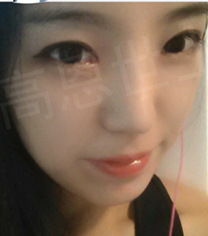 韩国德丽珍双眼皮+隆鼻手术前后对比
