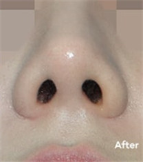 韩国VIP整形外科歪鼻矫正案例对比图