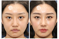 韩式肋骨隆鼻手术有什么优势和缺点？