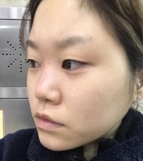 高诺鼻CONOPI整形外科-韩国高诺鼻整形外科塌鼻矫正手术照片