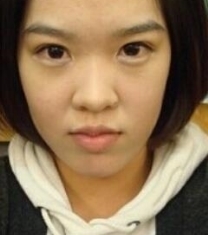 韩国高诺鼻医院福鼻整形手术前后对比照片_术前