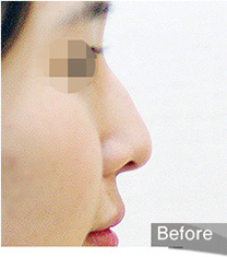 韩国olive驼峰鼻整形术后照片