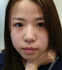 韩国普瑞美整形医院无假体福鼻矫正前后照片