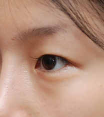 韩国妩丽医院双眼皮手术案例