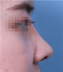 韩国朱诺整形外科-韩国朱诺蒜头鼻矫正一个月前后对比
