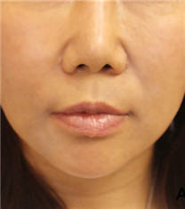 韩国朱诺面部吸脂+埋线提升手术前后变化对比_术后