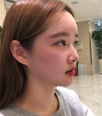 韩国普瑞美双眼皮隆鼻手术前后对比照片
