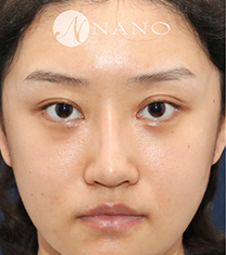 Nano整形外科-韩国nano鼻修复手术前后对比日记