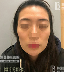 beautyline整形外科-韩国贝缇莱茵医院面部脂肪填充