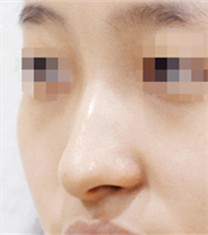 Olive整形外科-韩国olive整形外科假体隆鼻对比日记