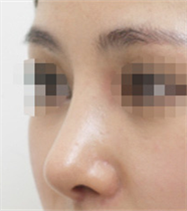 韩国olive整形外科自体软骨隆鼻对比案例