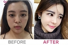 变美日记：韩国DA整形医院面部综合手术让我轻松拥有小萌脸