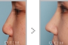 韩国motive整形怎么样，做眼鼻修复特色在哪里？