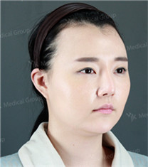JK整形美容医院-韩国JK发际线种植手术前后对比日记