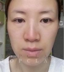 韩国顶级整形-韩国topclass立体隆鼻+面部提升手术前后对比照片