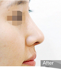 韩国olive驼峰鼻整形术后照片